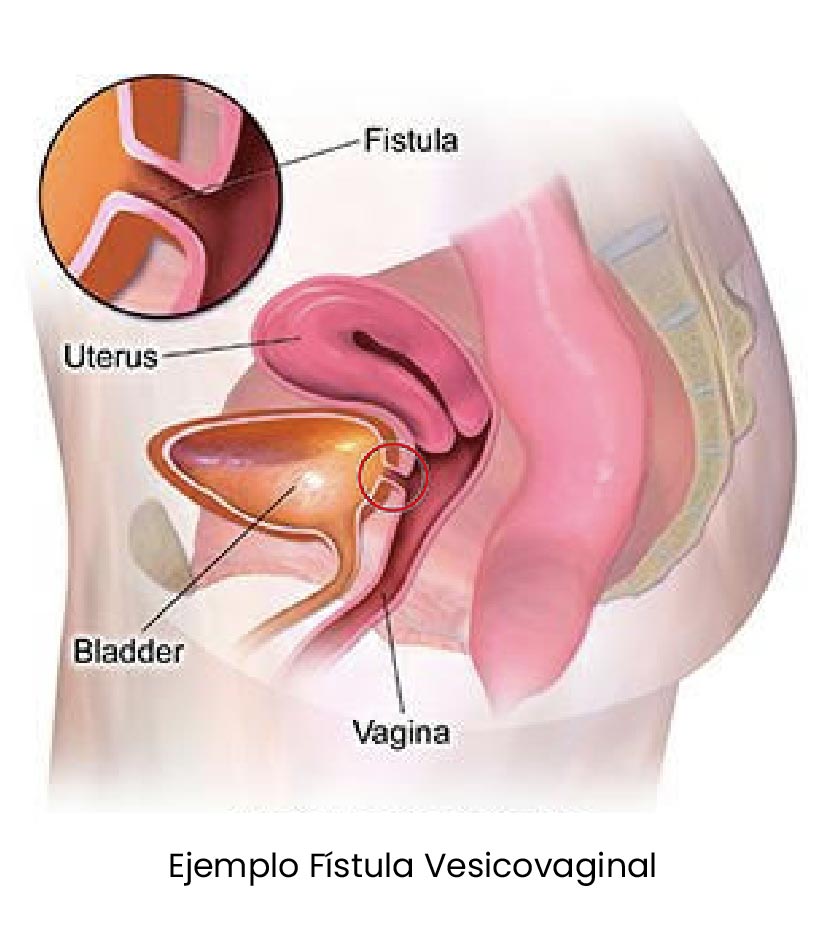 Fístula Vesicovaginal Fístula Vesicovaginal